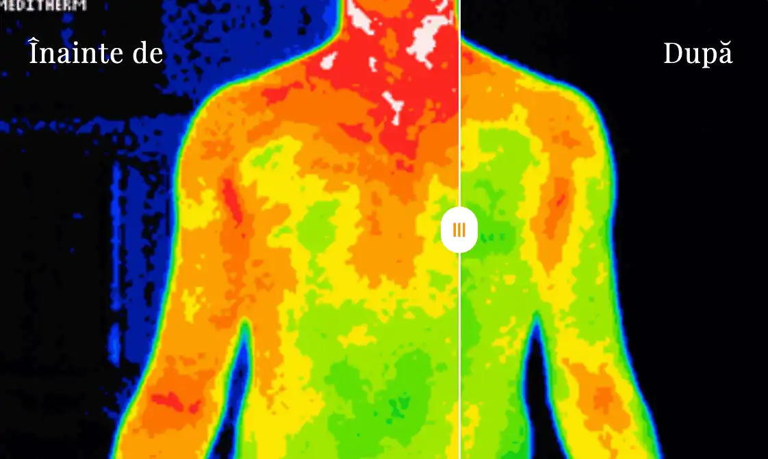 LAMININE termografie înainte și după - reducere inflamație și îmbunătățire circulație